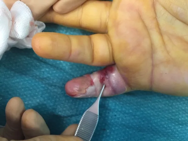 Aspect clinique d'un doigt atteint d'un phlegmon, rouge et inflammatoire, lors de l'intervention chirurgicale